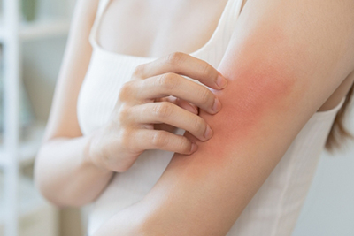 Rashes-Treatment-in-McKinney-TX
