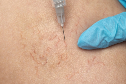 Spider vein treatment using sclerotherapy in McKinney, TX. Spider vein treatment using sclerotherapy in McKinney, TX.