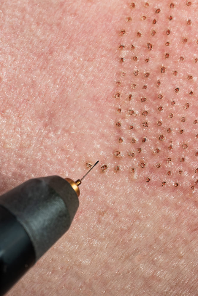 plasma pen treatment